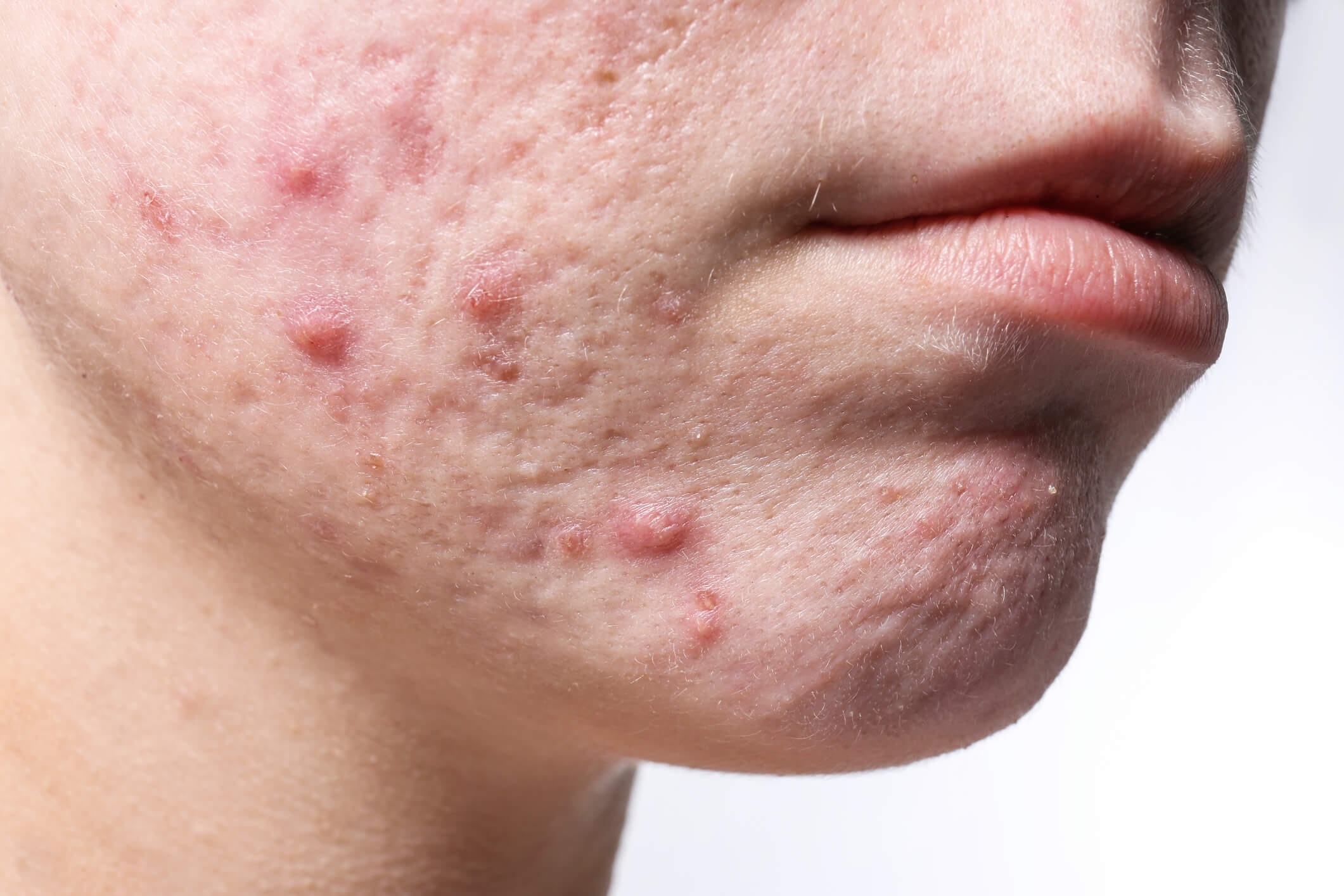 Can probiotics help with acne treatment