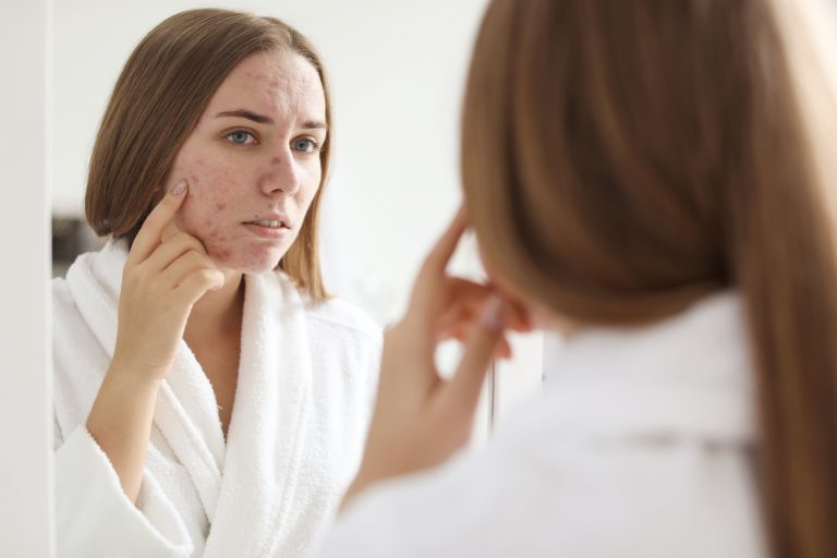 Possible Causes of Probiotic-Induced Acne