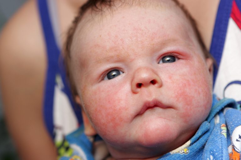 Can Probiotics Help With Eczema in Babies?