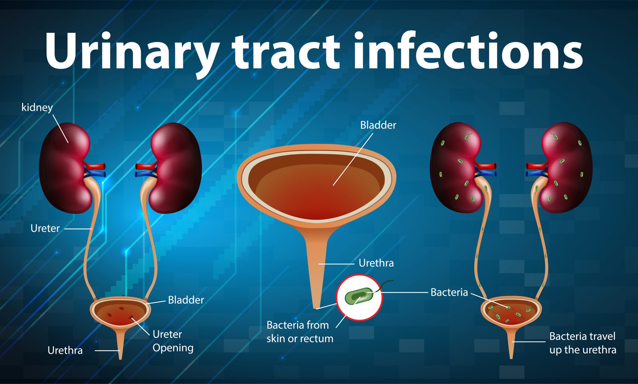 💊 How Do I Know If I Have a UTI?