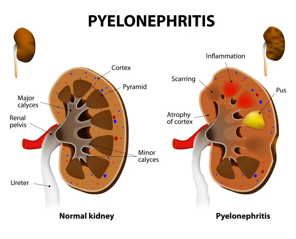 Normal kidney and Chronic Pyelonephritis - have a uti