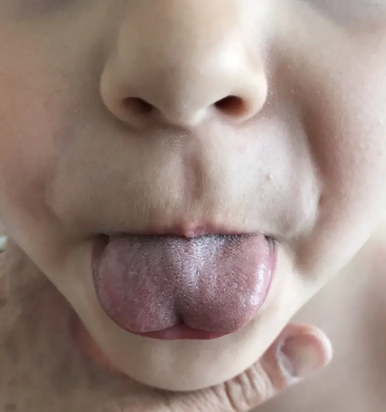 Is Thrush Contagious in Babies? Understanding the Transmission and Prevention of Oral Thrush
